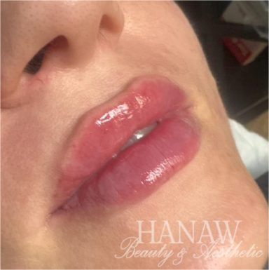 After lip filler London