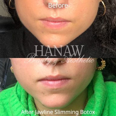 Jawline slimming botox London