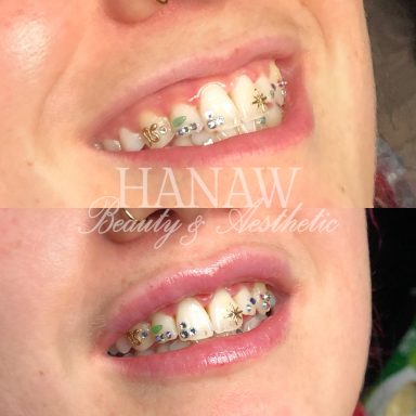 Before and after .5ml lip filler
